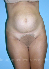 before front view tummy tuck of female patient 2814
