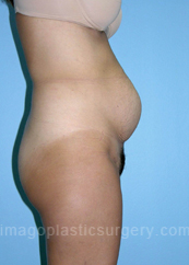 before right side view tummy tuck of female patient 2814