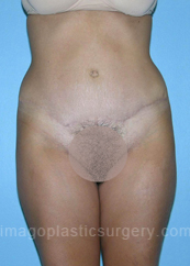 after front view tummy tuck of female patient 2814