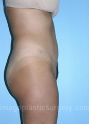 after right side view tummy tuck of female patient 2814