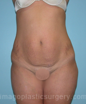before front view tummy tuck of female patient 2819