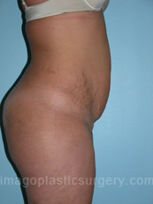 before right side view tummy tuck of female patient 2819
