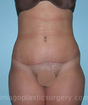 after front view tummy tuck of female patient 2819
