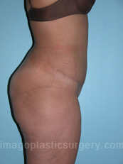 after right side view tummy tuck of female patient 2819