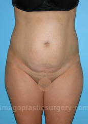 before front view tummy tuck of female patient 2825