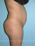 before right side view tummy tuck of female patient 2825