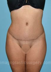after front view tummy tuck of female patient 2825
