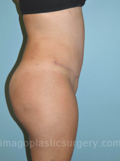 after right side view tummy tuck of female patient 2825