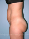 before left side view tummy tuck of female patient 2834