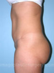 after left side view tummy tuck of female patient 2834