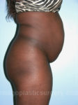 before right side view tummy tuck of female patient 2848