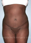 after front view tummy tuck of female patient 2848
