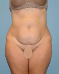 before front view tummy tuck of female patient 2861
