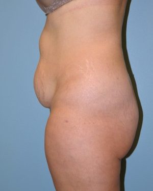 before left side view tummy tuck of female patient 2861