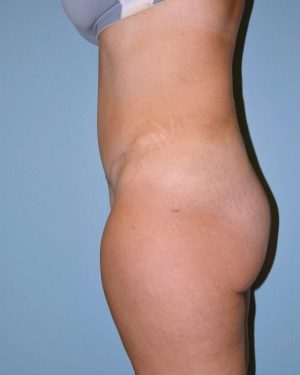 after left side view tummy tuck of female patient 2861