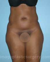 before front view tummy tuck of female patient 2866