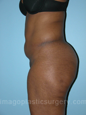 before left side view tummy tuck of female patient 2866