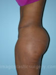 after left side view tummy tuck of female patient 2866