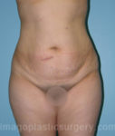 before front view tummy tuck of female patient 2871