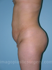 before left side view tummy tuck of female patient 2871