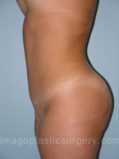 after left side view tummy tuck of female patient 2871