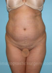 before front view tummy tuck of female patient 2882