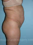 before right side view tummy tuck of female patient 2882