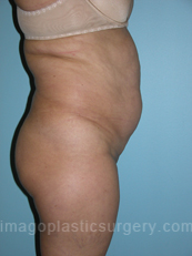 before right side view tummy tuck of female patient 2882