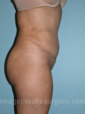 after right side view tummy tuck of female patient 2882
