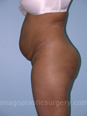 before left side view tummy tuck of female patient 2887