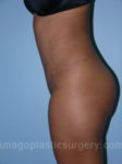 after left side view tummy tuck of female patient 2887