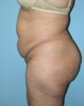 before left side view tummy tuck of female patient 2897