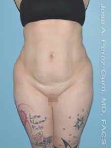before front view tummy tuck of female patient 2928