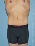After tummy tuck front view male patient case 5011