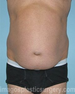 Before tummy tuck front view male patient case 5016