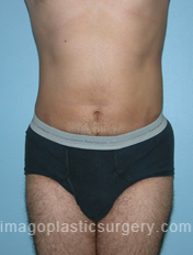 After tummy tuck front view male patient case 5033