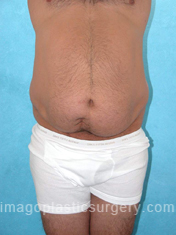 Before tummy tuck front view male patient case 5040