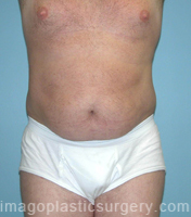 Before tummy tuck front view male patient case 5045