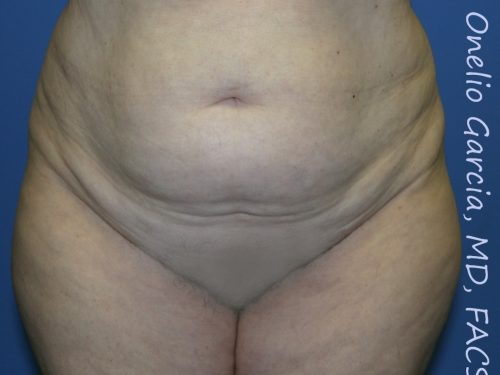 before front view vaser lipo of female patient 3119