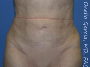 after front view vaser lipo of female patient 3119