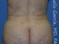 after back view vaser lipo of female patient 3119