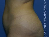 before left side view vaser lipo of female patient 3124