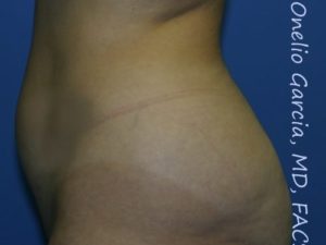 before left side view vaser lipo of female patient 3124