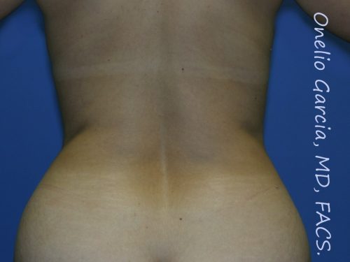 before back view vaser lipo of female patient 3124