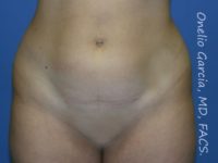 before front view vaser lipo of female patient 3124
