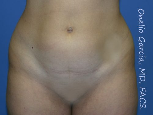before front view vaser lipo of female patient 3124