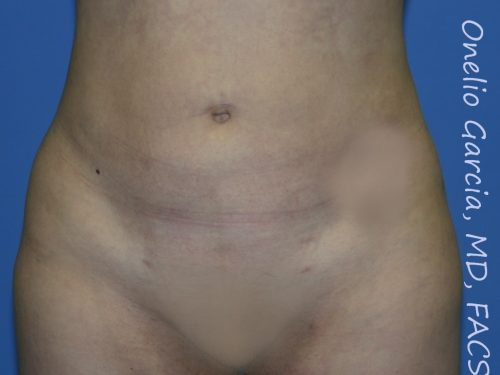 after front view vaser lipo of female patient 3124