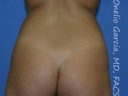 before back view vaser lipo of female patient 3134