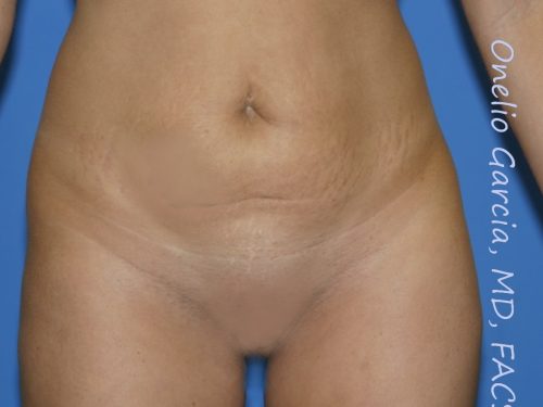 before front view vaser lipo of female patient 3134