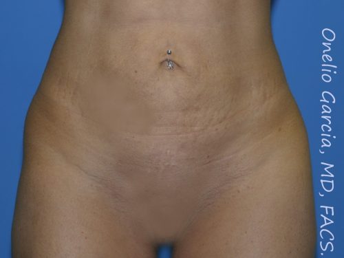 after front view vaser lipo of female patient 3134